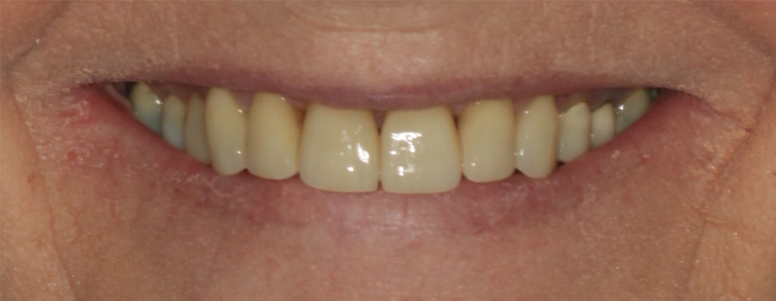 Karen — Smile Makeover - After