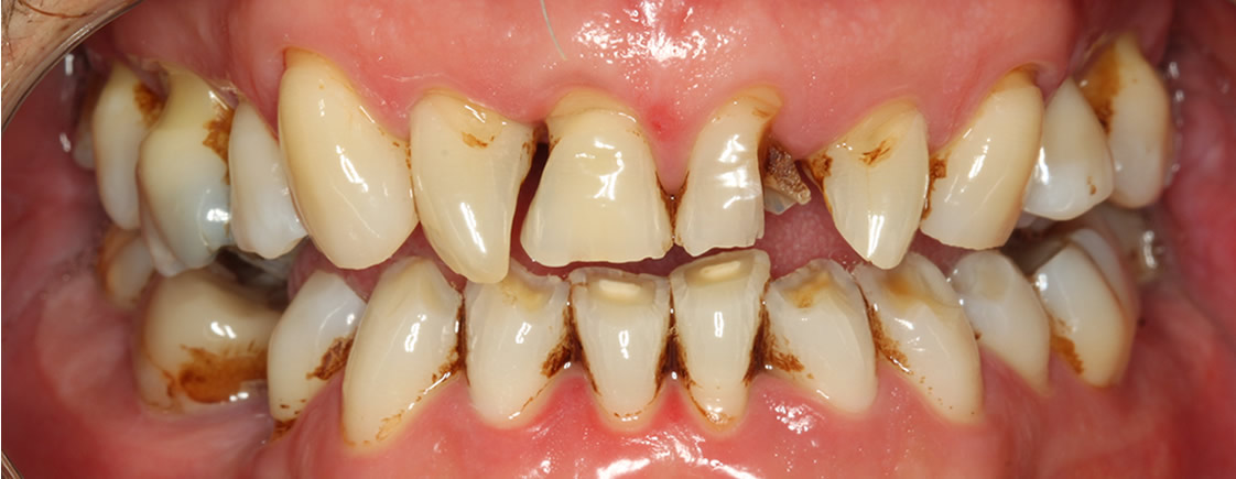 Rohan — Smile Makeover - Before