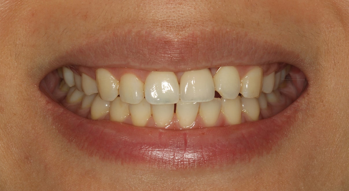 Valarie — Dental Implant - After