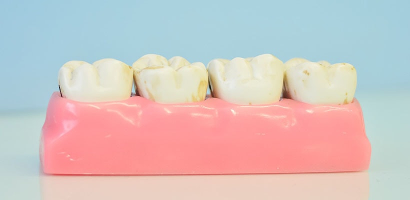 icture of gums and teeth to show what gum disease is and how to treat and prevent it